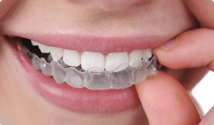 Clear Aligners
