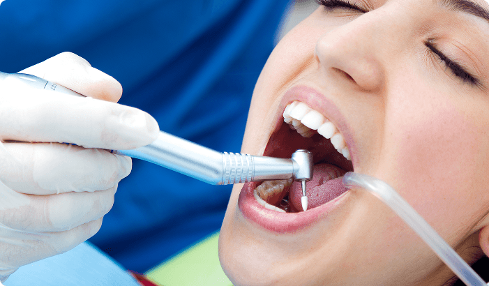 Dental Fillings