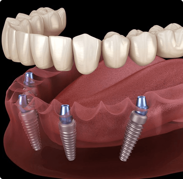 All‑On‑X / Full‑Arch Solutions