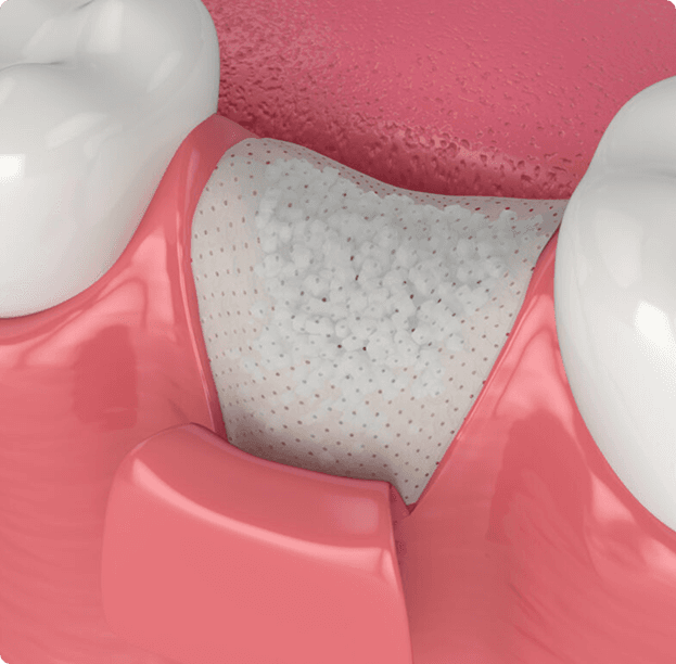Alveoloplasty (Ridge Smoothing)