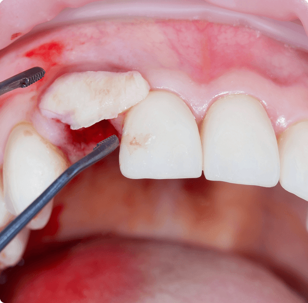 Soft Tissue & Gum Grafting