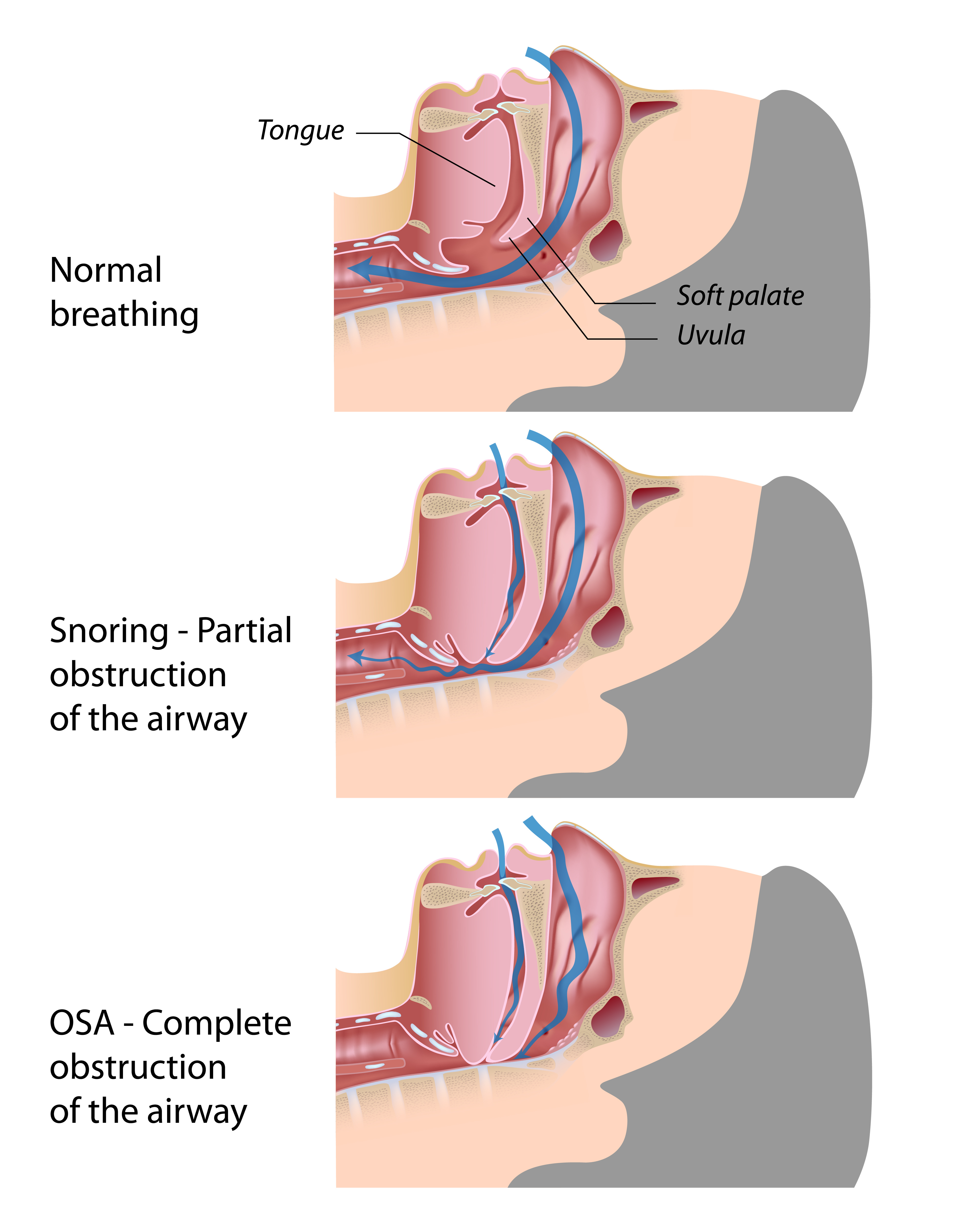 SleepApnea.jpeg